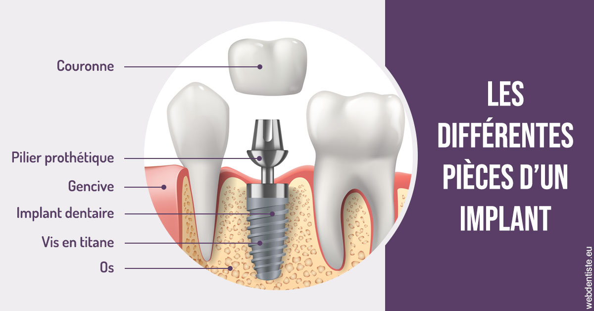 https://www.orthodontiste-vaud-geneve.ch/Les différentes pièces d’un implant 2