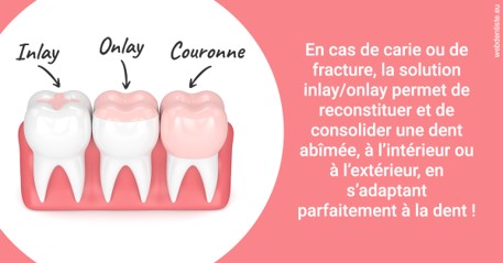 https://www.orthodontiste-vaud-geneve.ch/L'INLAY ou l'ONLAY 2