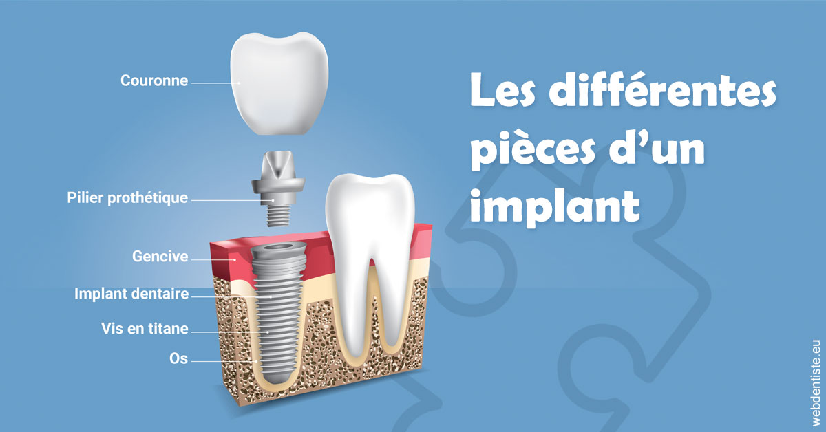 https://www.orthodontiste-vaud-geneve.ch/Les différentes pièces d’un implant 1