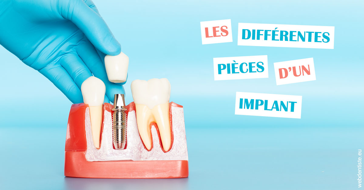 https://www.orthodontiste-vaud-geneve.ch/Les différentes pièces d’un implant 2